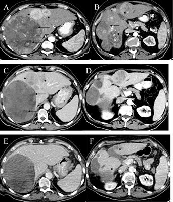 Case report: The efficacy of adding high doses of intravenous vitamin C to the combination therapy of atezolizumab and bevacizumab in unresectable HCC